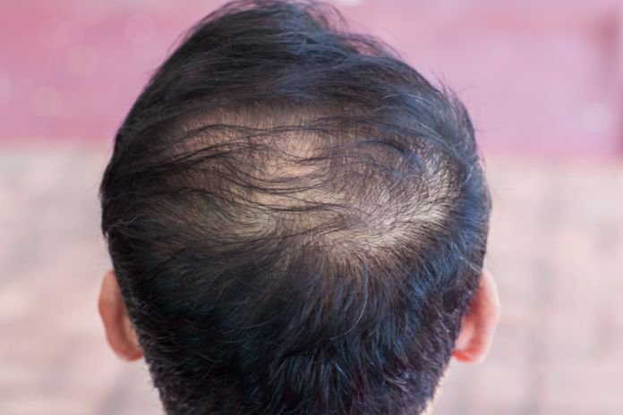 A Comprehensive Guide to Hair Fall Control for Men